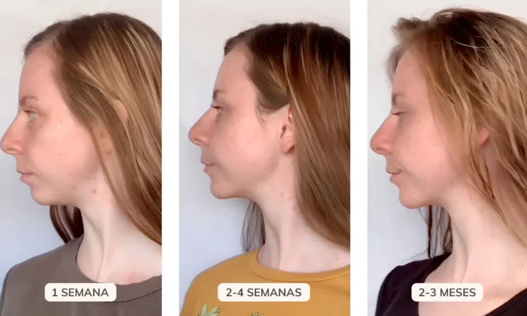 Resultados Gua Sha por semanas: 1 semana, 4 semanas y 3 meses de uso constante